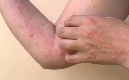 Satu Pasien Mpox Meninggal Dunia, Disebabkan Komorbid Berat